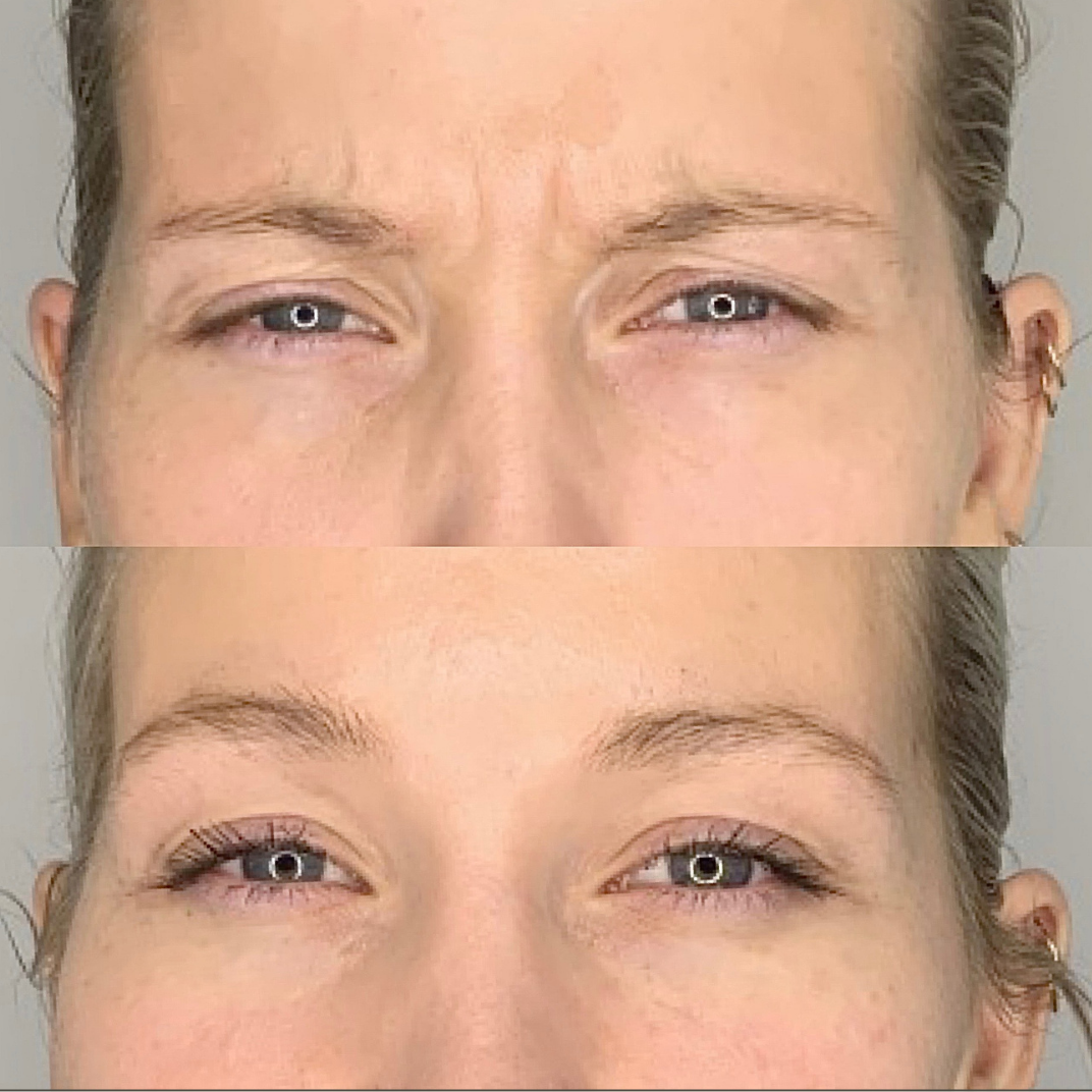Botox – før og efter, eksempel 1