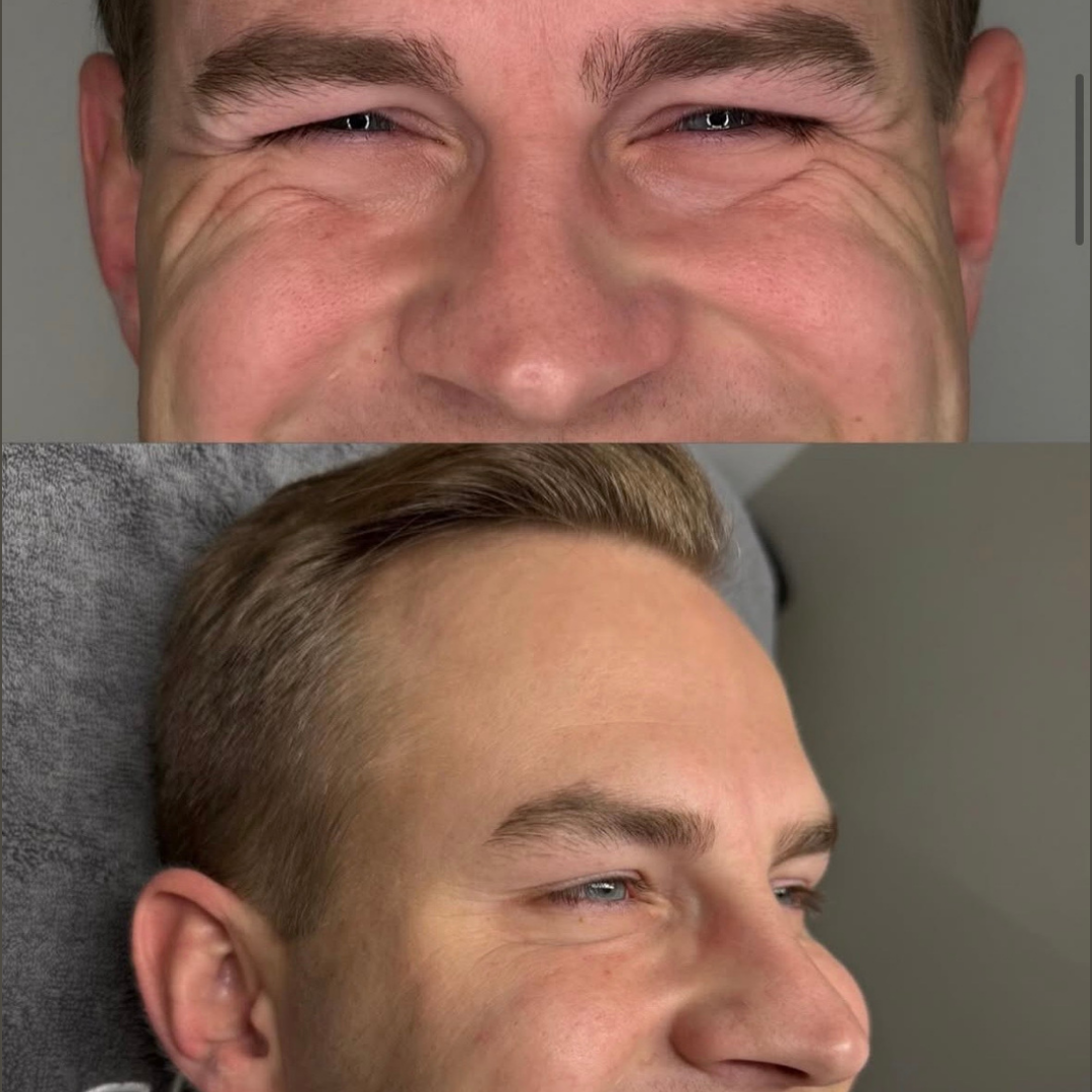 Botox – før og efter, eksempel 2