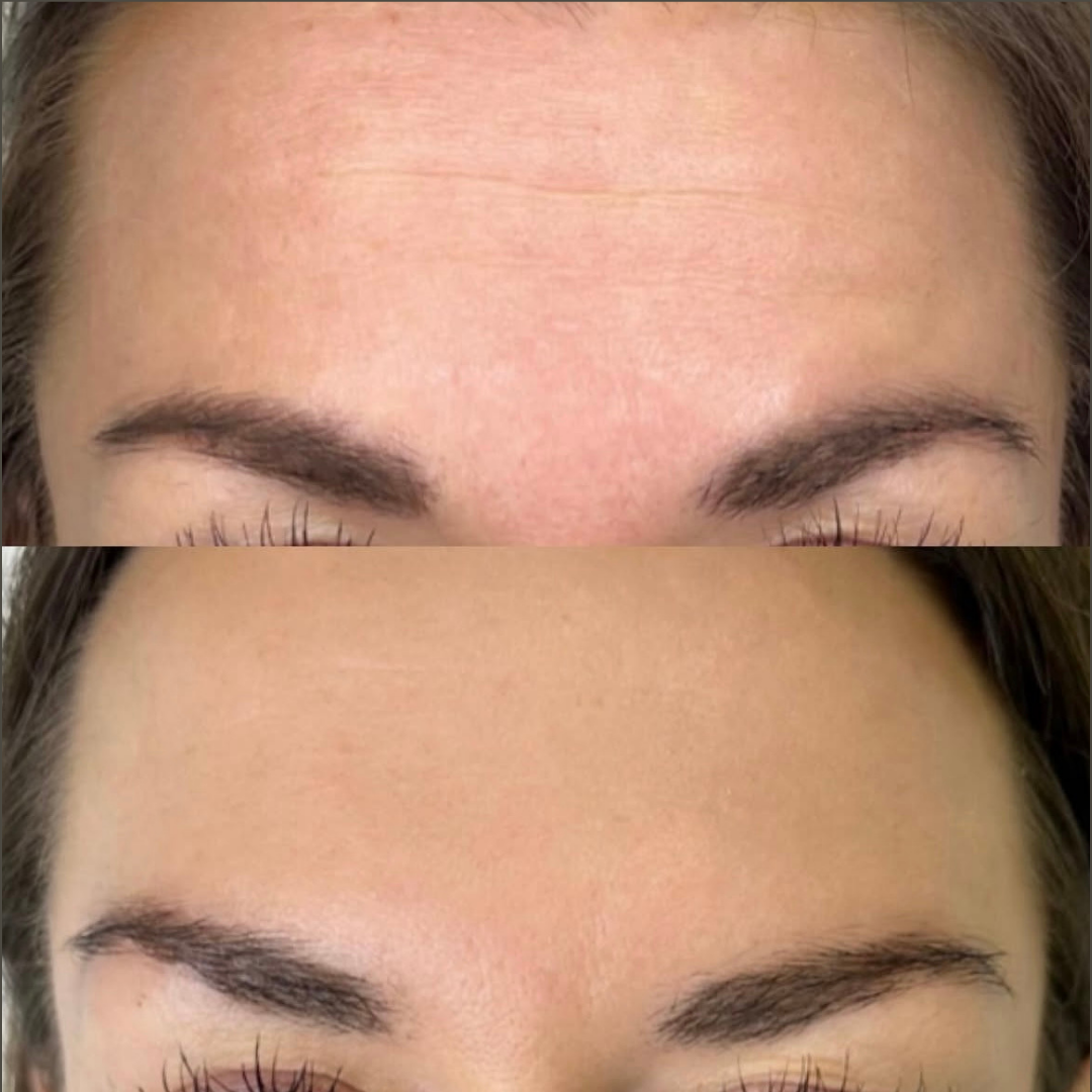 Botox – før og efter, eksempel 4