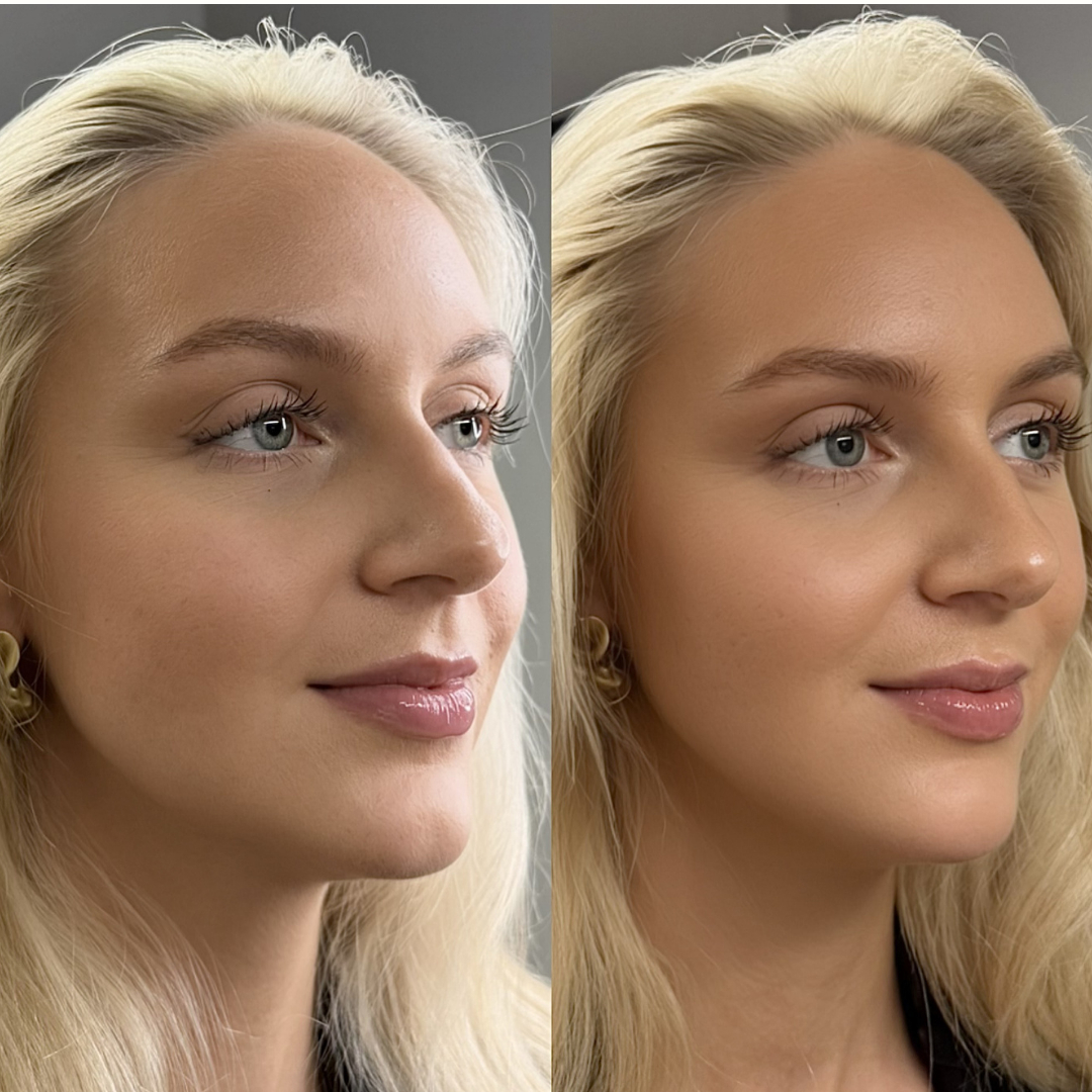 Filler – før og efter, eksempel 2