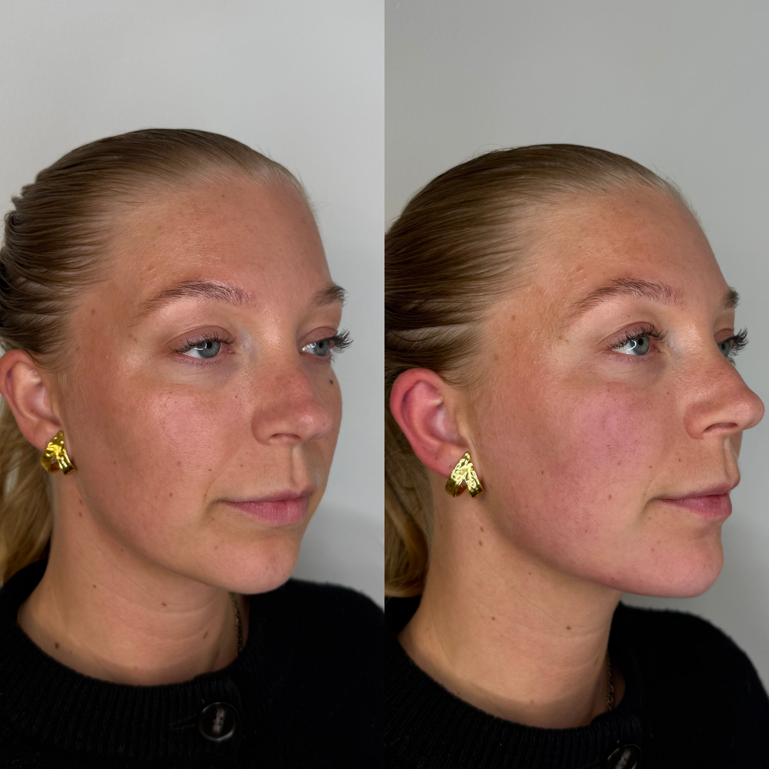 Filler – før og efter, eksempel 7