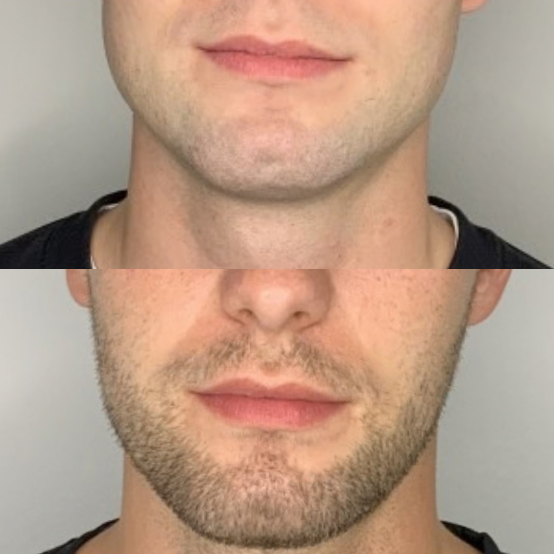 Botox – før og efter, eksempel 3