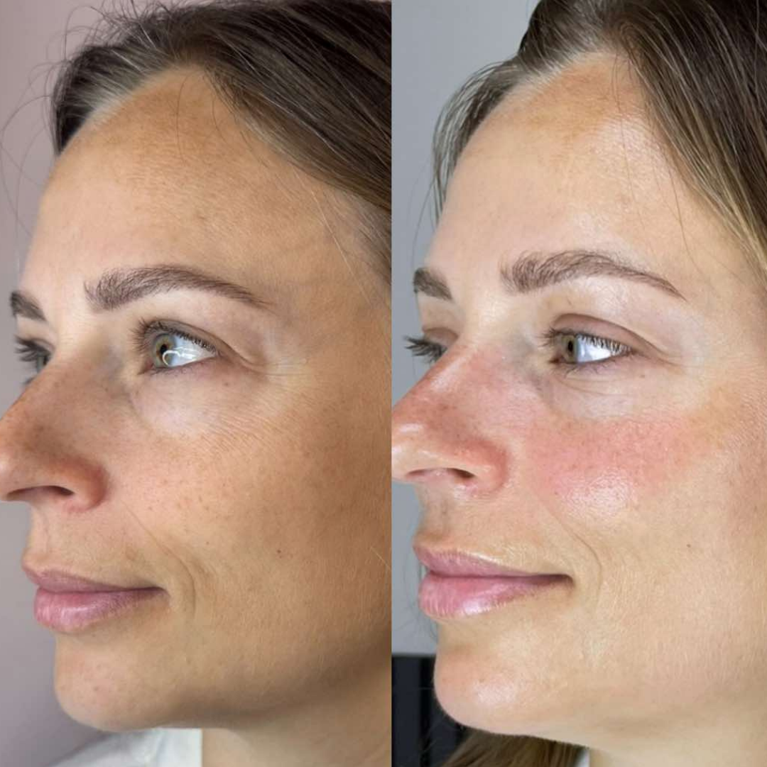 Glass Skin Facial – før og efter, eksempel 2