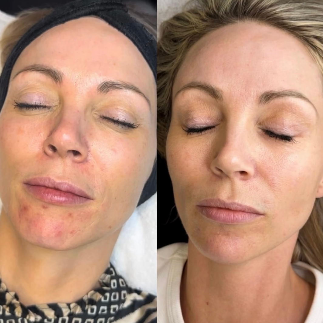 Kombinationsbehandling – Fraktioneret Pico Rejuventaion & Microneedling