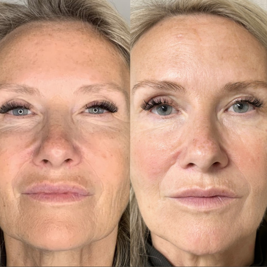 Skinbooster – før og efter, eksempel 3