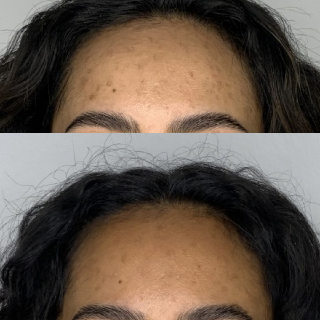 Microneedling PRF