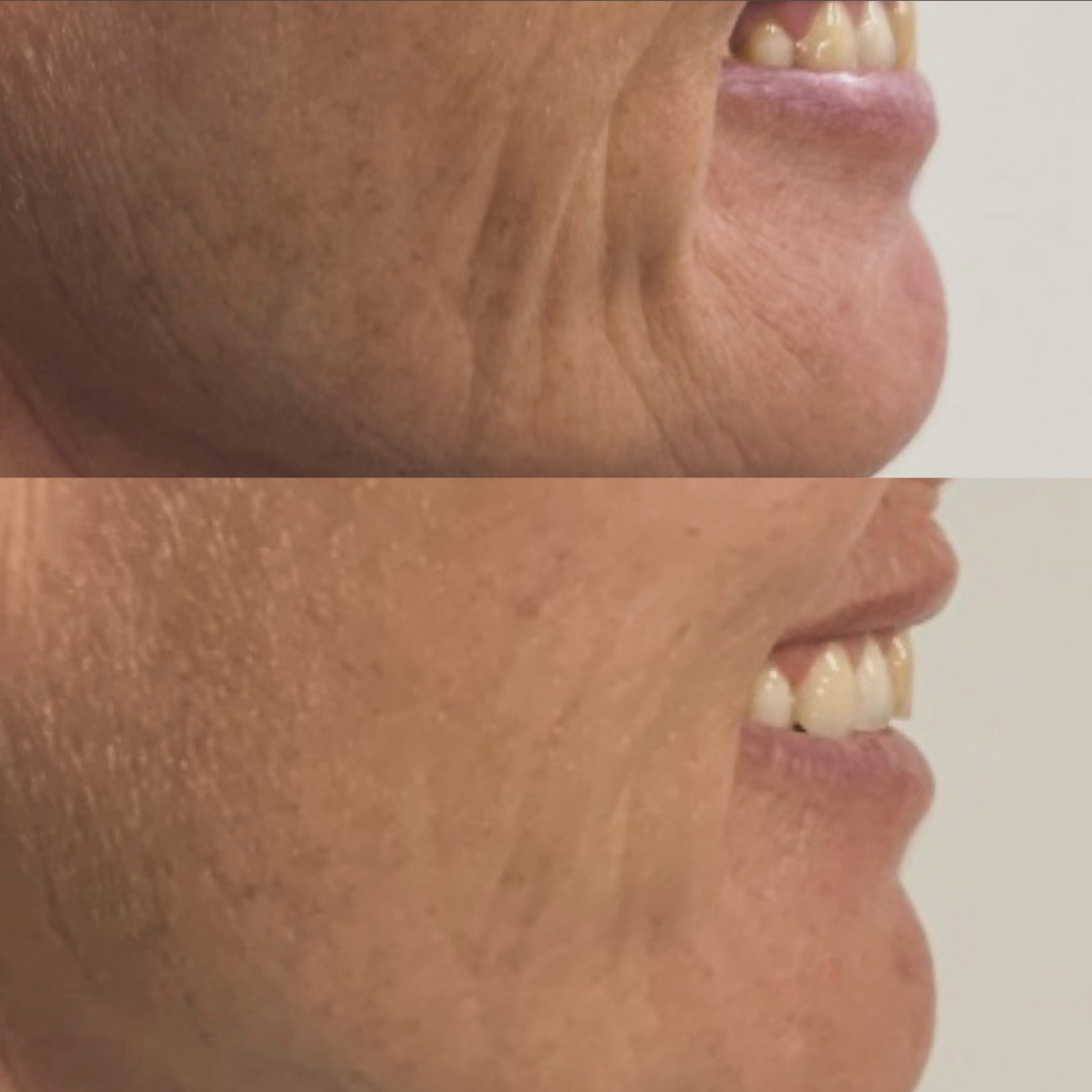 Skinbooster – før og efter, eksempel 1