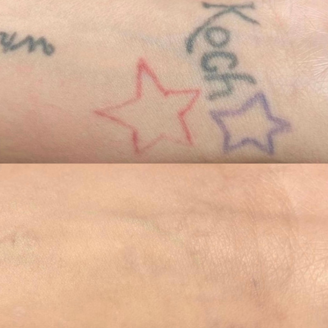 Tatoveringsfjernelse – før og efter, eksempel 3