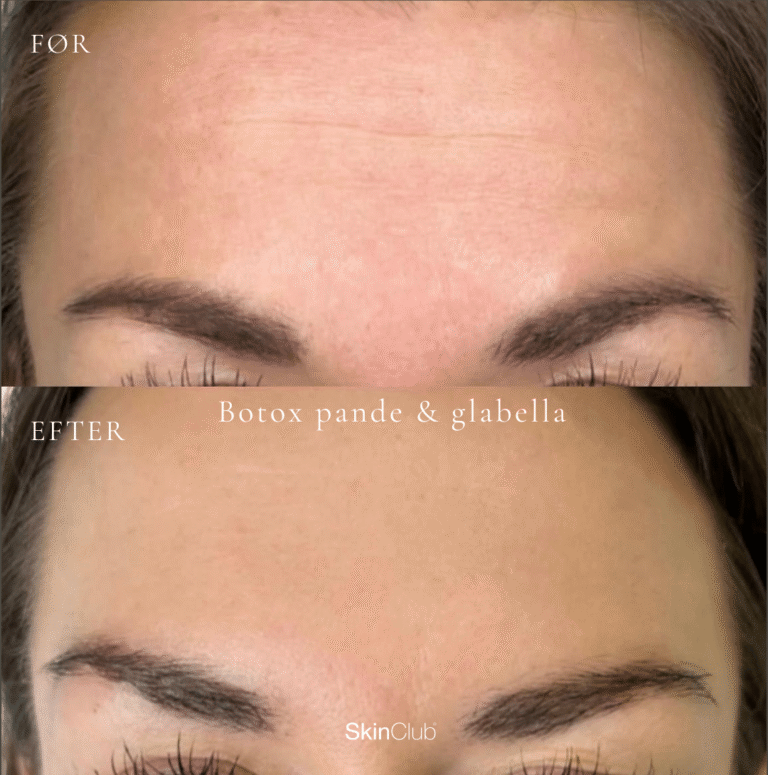 skinclub botox