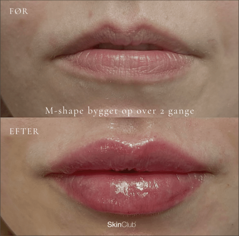 skinclub filler læber
