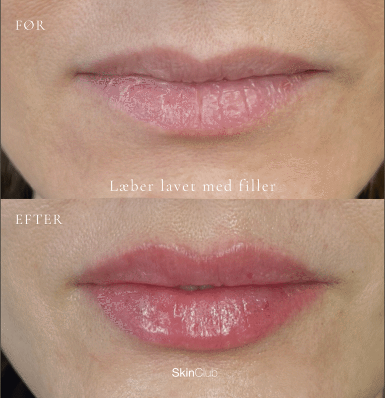 skinclub filler læber